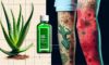 Burn Treatment Essentials: Effective Care Steps to Follow